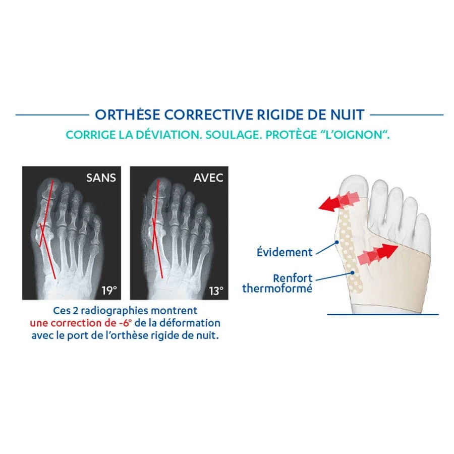 Epitact Orthosis for night correction of hallux valgus x1