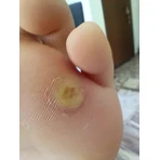 PharmaQ Acetocaustin for Warts 0.5ml