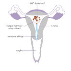 Sterilet IUB Ballerina, 1 pezzo, Ocon Medical Ltd.